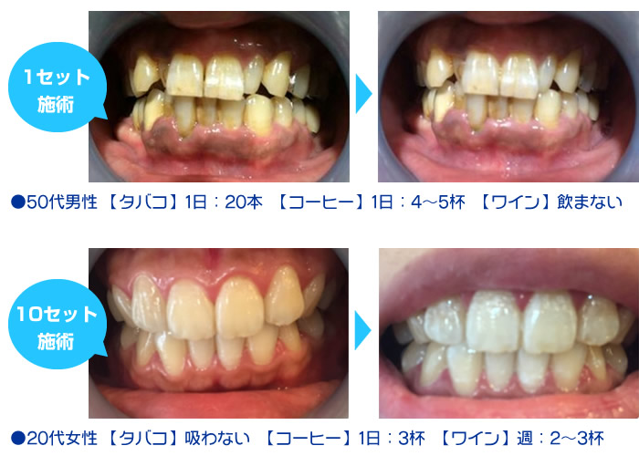 セルフホワイトニング 美歯口 びはく – 鳥取市の美容室レーブ reve